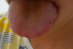 喉咙发炎可以吃瓜吗,瓜类食物的适宜与否探讨